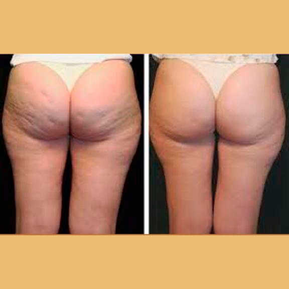 Carboxiterapia