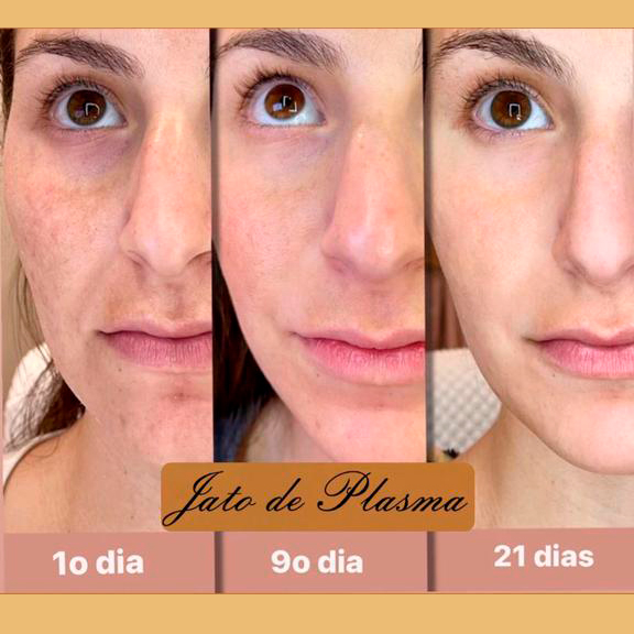 Jato de Plasma