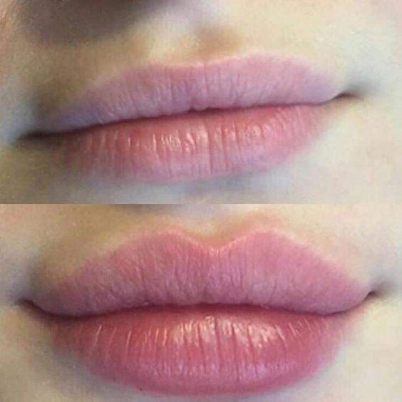 Preenchimento Labial