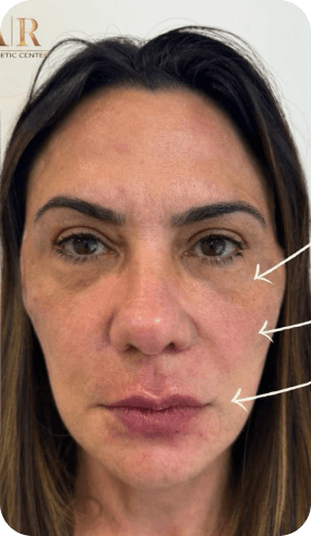 fio de pdo antes e depois