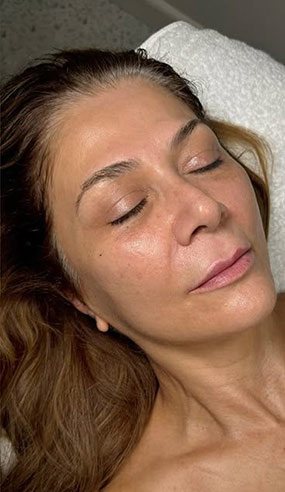 fio de sustentação antes e depois