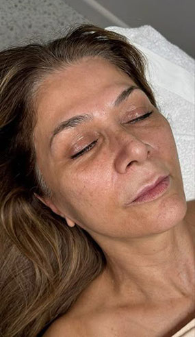 fio de sustentação antes e depois