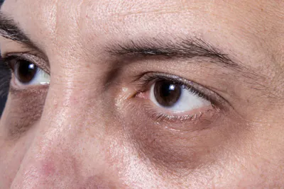 bolsas dos olhos