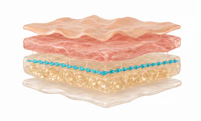 Ilustração 3D de fios de PDO inseridos no tecido subcutâneo da pele facial